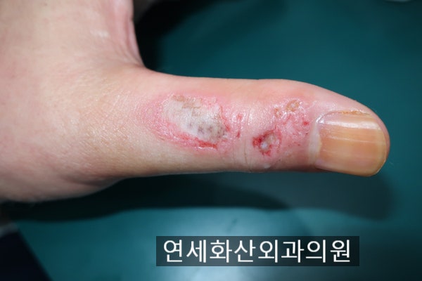 [송파 피부종양 수술] 손가락에 12