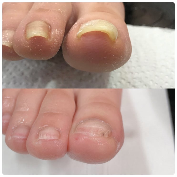  문경 안동 내성발톱, 무좀발톱, 발각질 전문가가 있는곳 페디아이티엔 & 네일로젤린