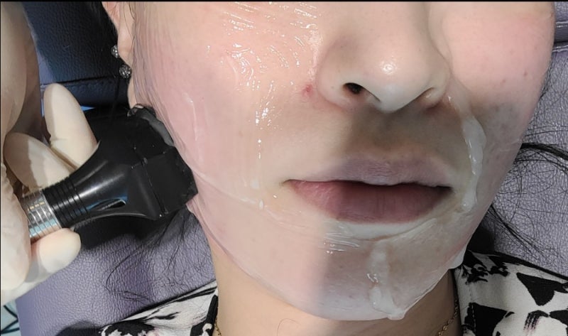 서면피부과 모드포마 후기, 피부 탄력에 직격탄인 듯.