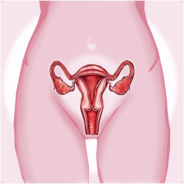 자궁적출수술후유증? 산부인과 전문의가 밝히는 충격적 진실