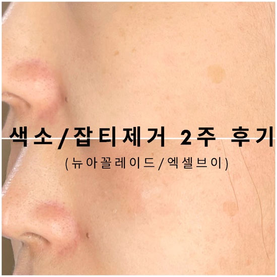  색소침착 제거 엑셀브이 레이저& 주근깨레이저 2주 후기