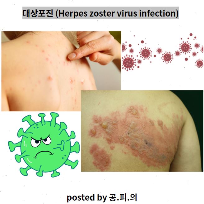  대상포진의 (Herpes zoster) 원인, 증상, 진단, 치료, 예방접종 [feat. 수두, 단순포진]