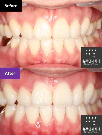 원데이 치아미백으로 치과 치료 받은 전후사진