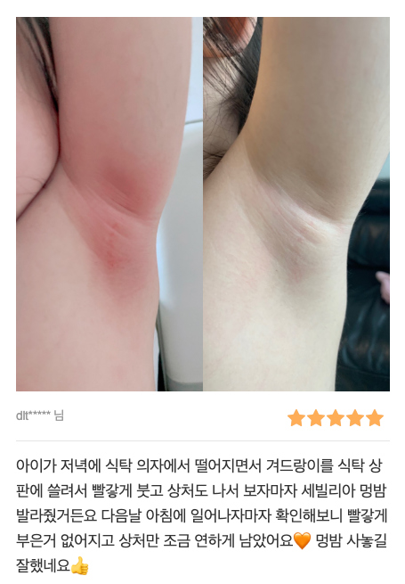  멍빨리빼는법 세벨리아 멍연고 엘씨이밤