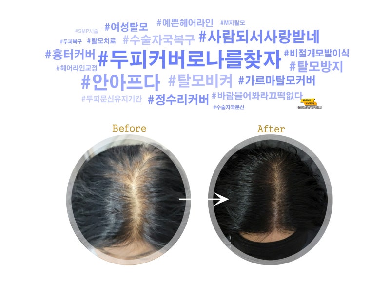 남양주에서 탈모를 커버하는 경우가 많은 곳을 추천합니다. 7