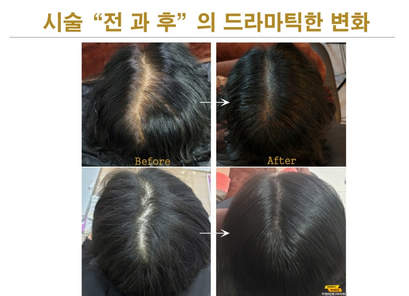 남양주에서 탈모를 커버하는 경우가 많은 곳을 추천합니다. 12