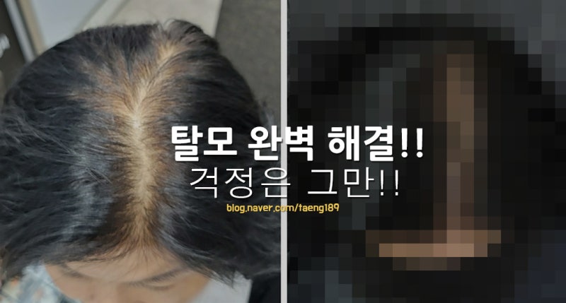 남양주에서 탈모를 커버하는 경우가 많은 곳을 추천합니다. 6