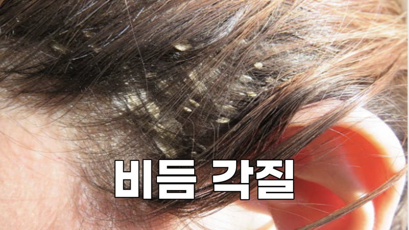 비듬샴푸로 환절기에 모발 비듬을 없애는 방법 두피각질관리리뷰