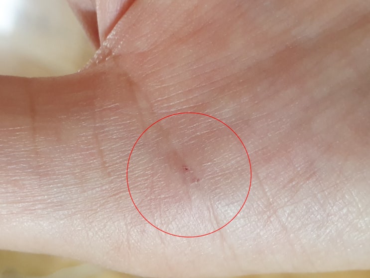  엄지손가락 마디통증 방아쇠수지증후군 주사 치료 받았어요