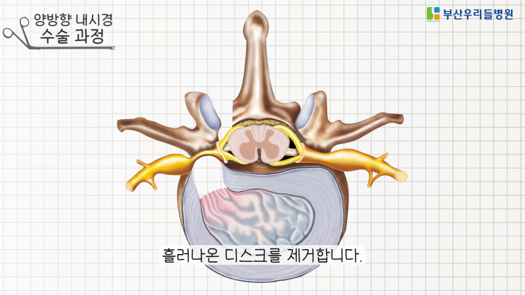  양방향 척추 내시경, 쉽게 설명해드릴게요! 온천장 역 맞은편 우리들병원