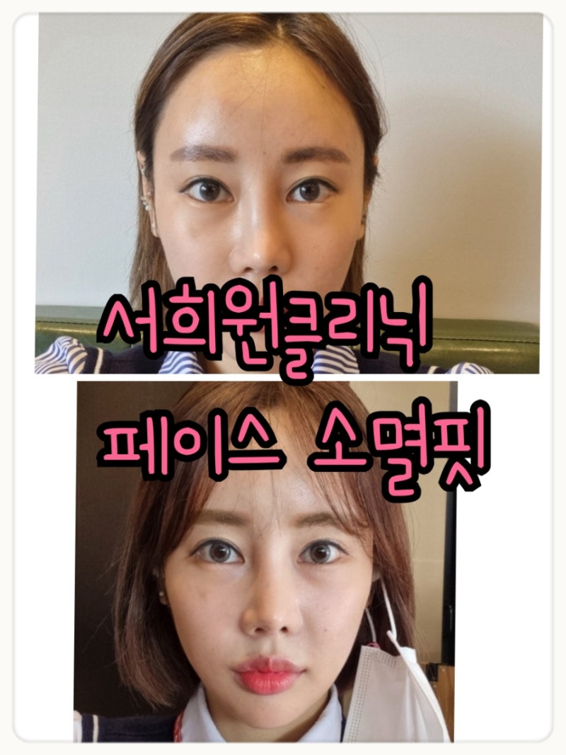 청담동윤곽주사 후기 :: 청담피부과 이중턱주사 효과 2