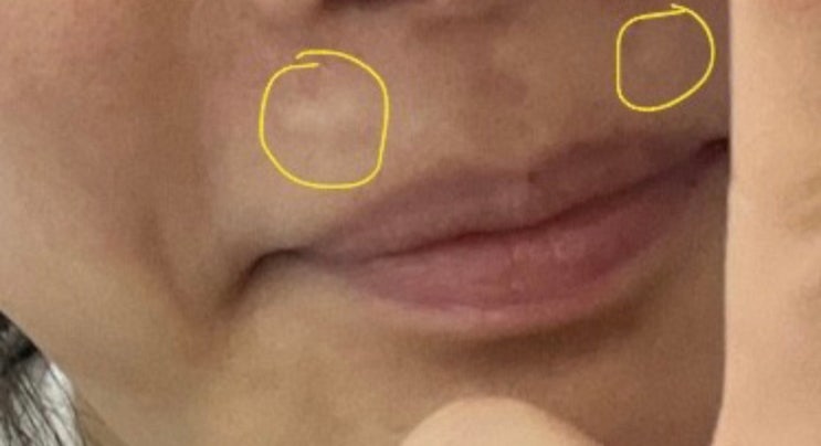 히알라제주사 3번맞음 팔자필러맞은게 내려온건가? 인중에 필러가..뜨든