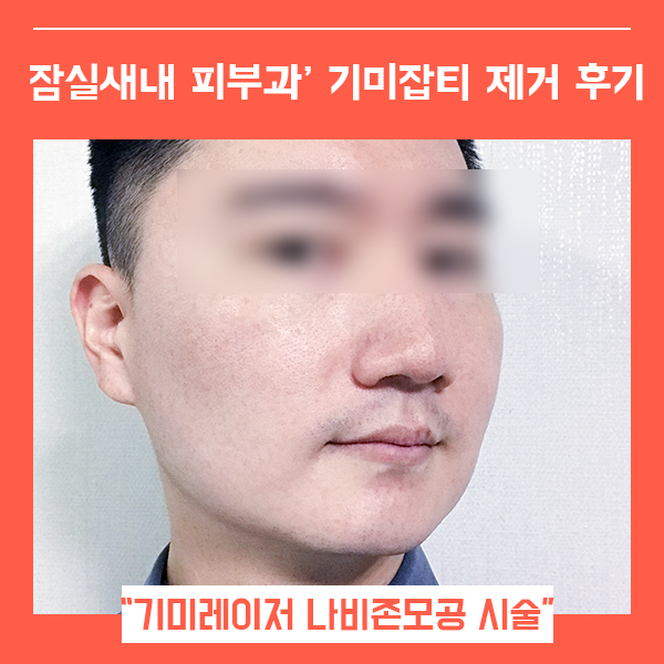 잠실새내 피부과 자극없이 깨끗한 기미레이저 (feat. 나비존모공 까지 매끈 )