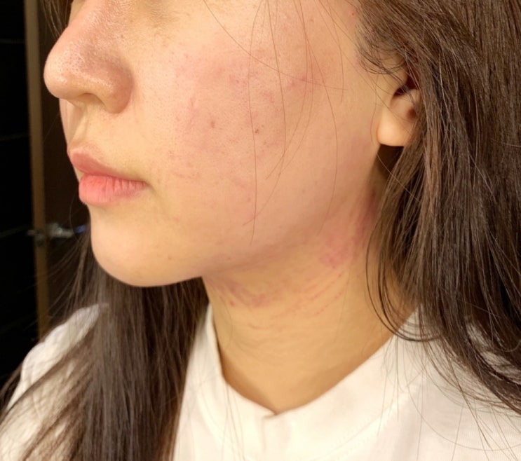  압구정 리프팅 인어젯 (인모드 에어젯) 저랑 잘 맞는걸 이제야 찾음
