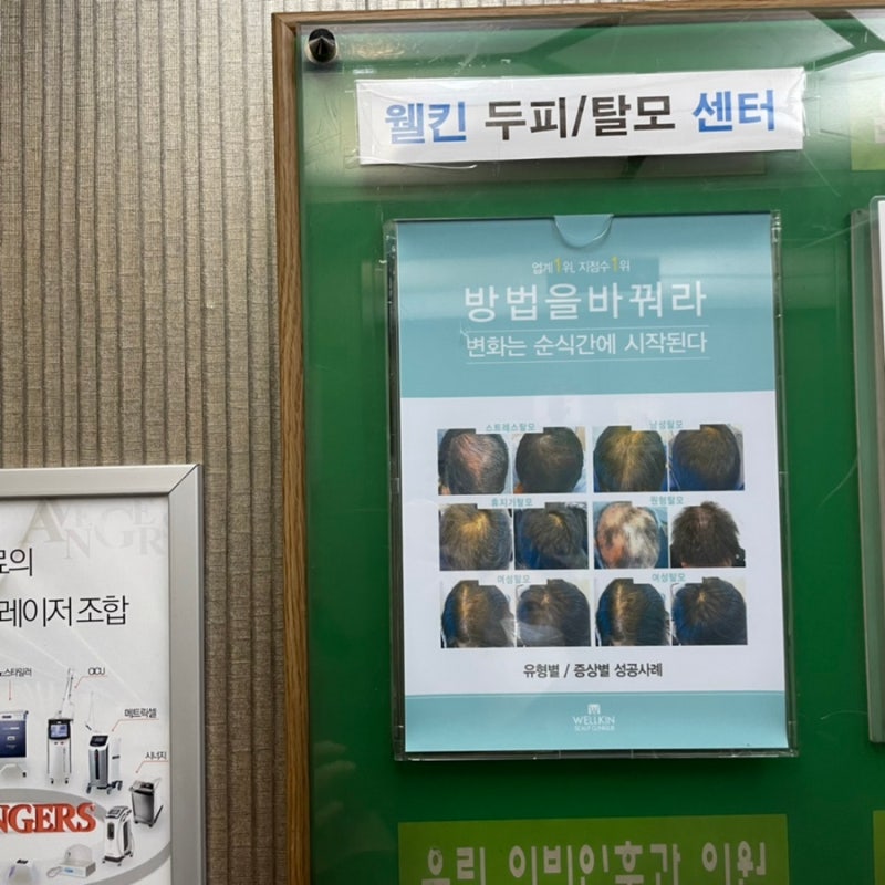 울산탈모클리닉 두피가 비어보이는게 느껴지기 시작하면 9