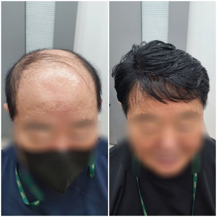  이제 부터 이식증모야2 가발덕후 은주누나와 함께라면 탈모 걱정 뚝!!  [춘천김호증모가발 ㆍ헤어증모술전문점]