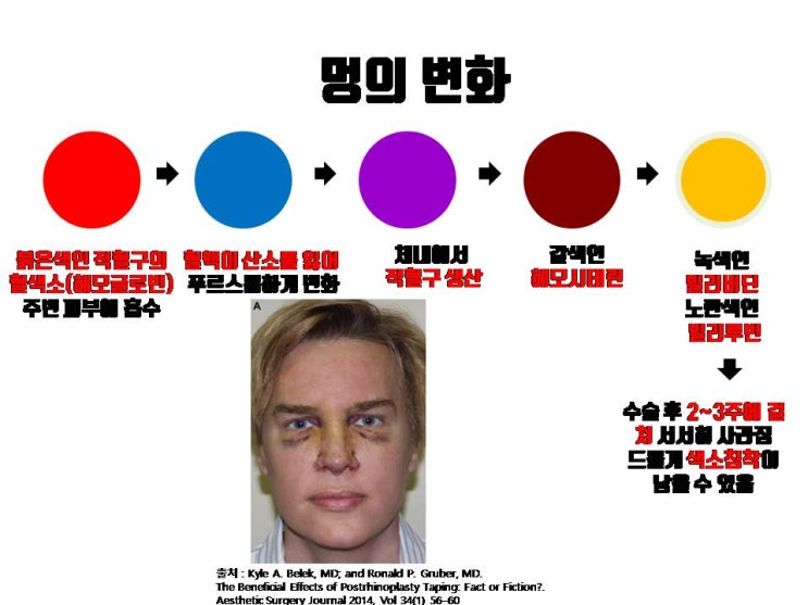  코수술 후 멍이 심하게 들어도 멍은 반드시 없어지나요? 색소 침착이 남지는 않나요?