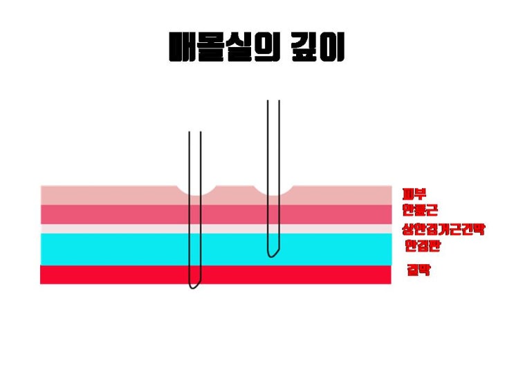  매몰 쌍꺼풀 푸는 것 쉽다고 생각하는데 매몰실 풀기 절대 쉽지 않아요!!!