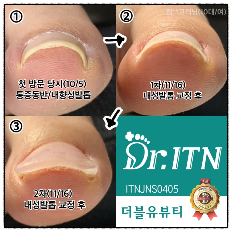  구례 곡성 내성발톱, 발톱무좀 발각질 더블유뷰티 깔끔한관리에 만족