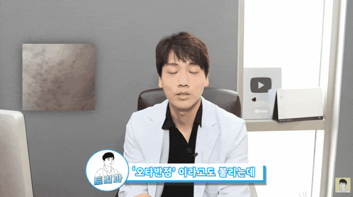  양측성오타모반? 후천성이라 스트레스 받으시는 분들께