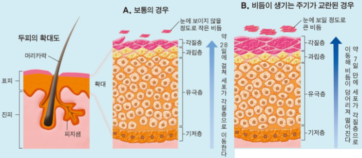  피부이야기_#비듬&지루성두피염 원인 및 추천성분