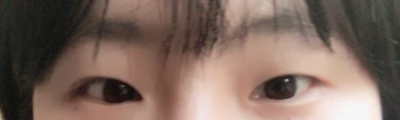 쌍커플 수술 2주 이후 ~ 한달 변화 후기 (미방은 성형 전) 쌍커플 수술 2주 이후 ~ 한달 변화 후기 (미방은 성형 전)