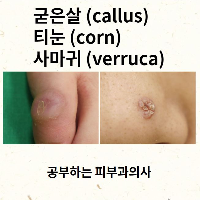  굳은살 티눈 사마귀 생기는 이유 그리고 감별점