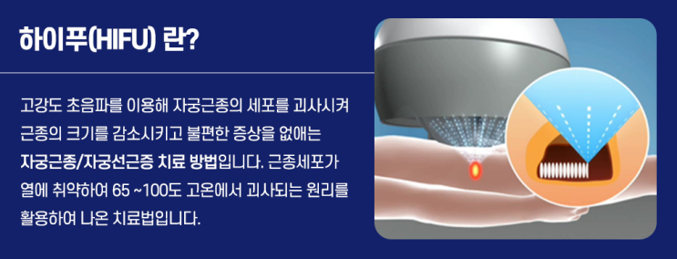  자궁근종 보험금 청구, 하이푸<시술>로 <수술비> 보장받을 수 있을까요?