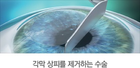  광주라식,라섹 요즘 유행하는것과 차이점 -광주안과 서포터즈