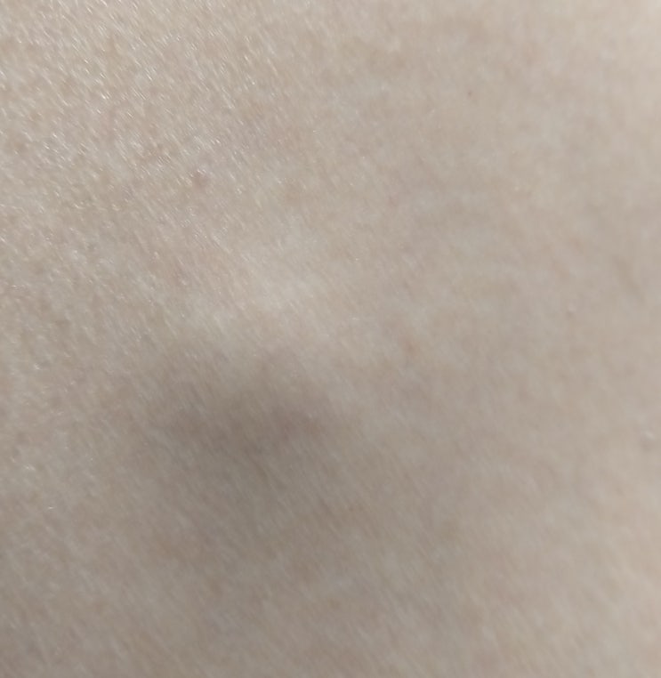  피지 낭종 제거 수술 간단하네요.(with. 지방종)