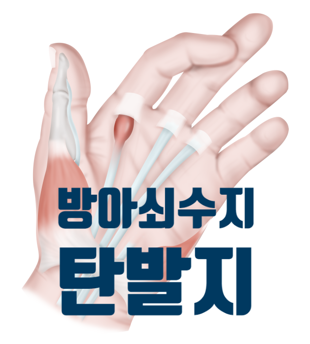  방아쇠수지, 방아쇠손가락, 탄발지, Trigger finger