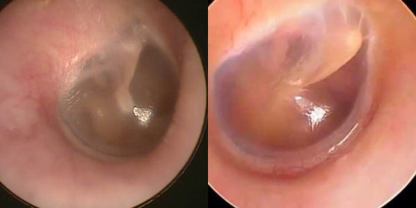 귀에서 바스락 거리는 소리가 나요. 귀 파면 안되는 이유 : 네이버 블로그