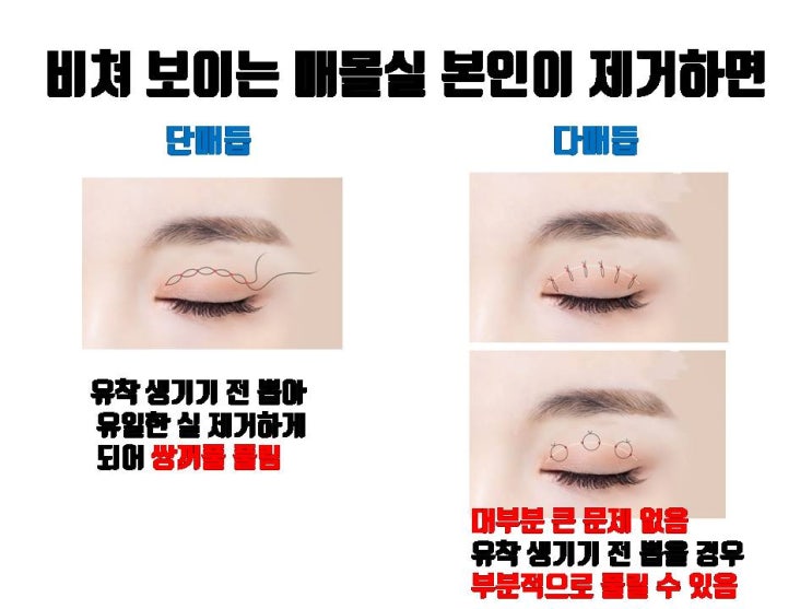 매몰실 비춰 보인다고 직접 매몰실 제거하면 쌍꺼풀 풀릴 수 있어요!!!