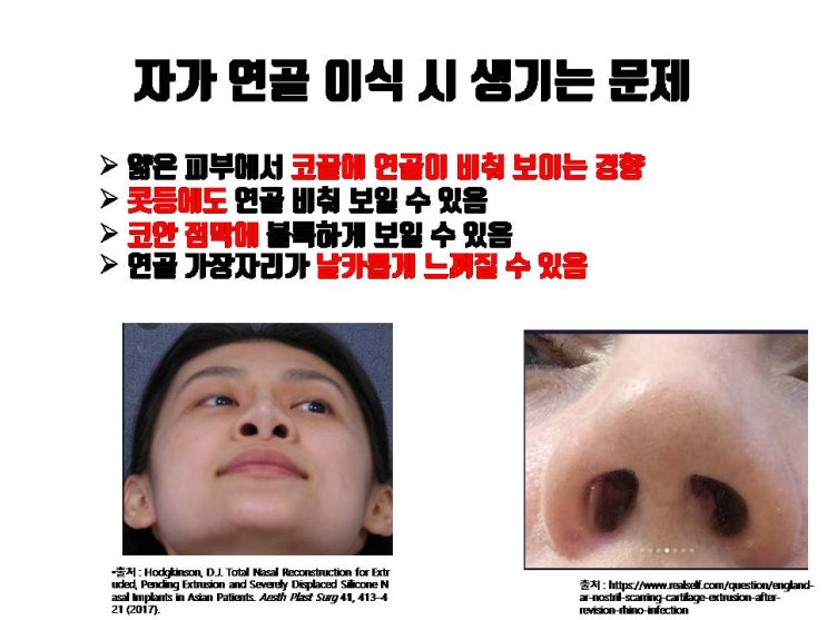  자가 연골로 코끝 성형 후 코끝 연골 비침은 큰 염려 안 하셔도 괜찮아요!!!