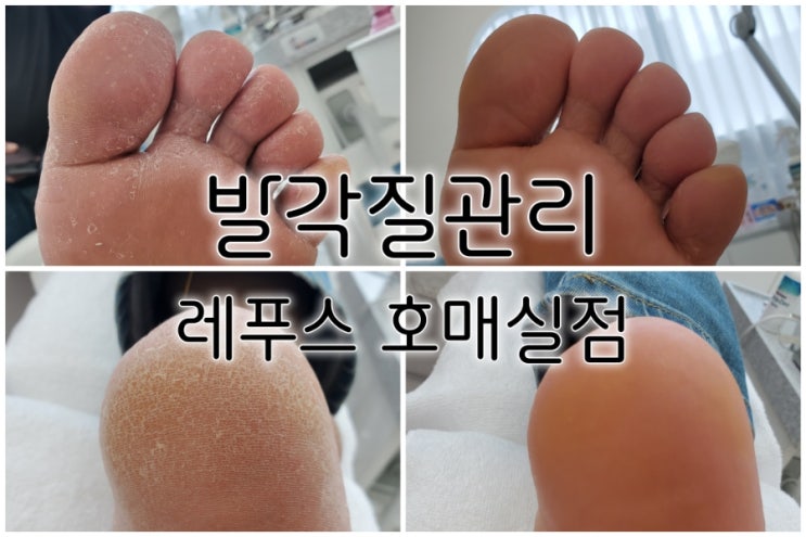 수원 발각질 레푸스 호매실점 깨끗해진 발 찐후기 수원 발각질 레푸스 호매실점 깨끗해진 발 찐후기
