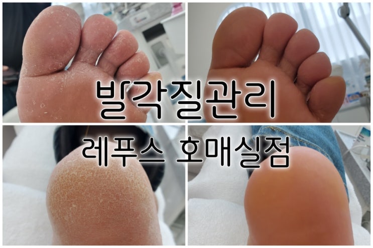 수원 발각질 레푸스 호매실점 깨끗해진 발 찐후기