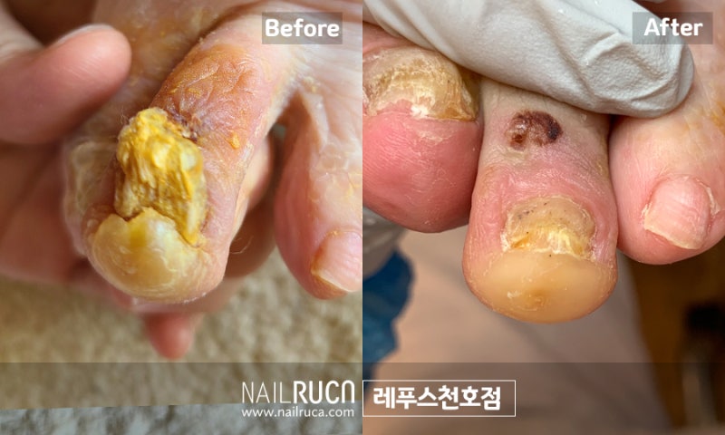 부모님을 위한 노인손톱무좀, 고령손톱무좀 관리를 잘 하는 방법!!!