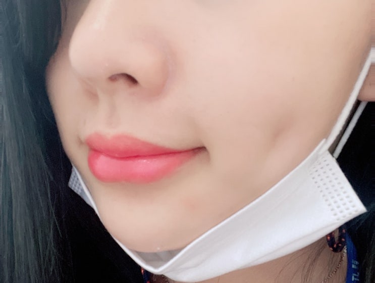  보조개 재수술 3일차 경과, 통증, 붓기 등의 기록