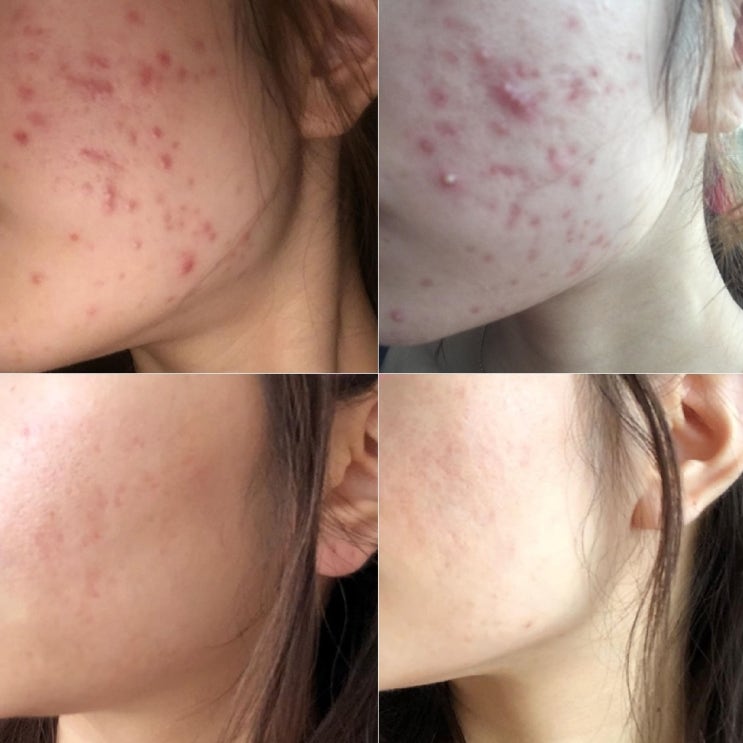  누르면 아픈 여드름 압출 후 관리 베스트