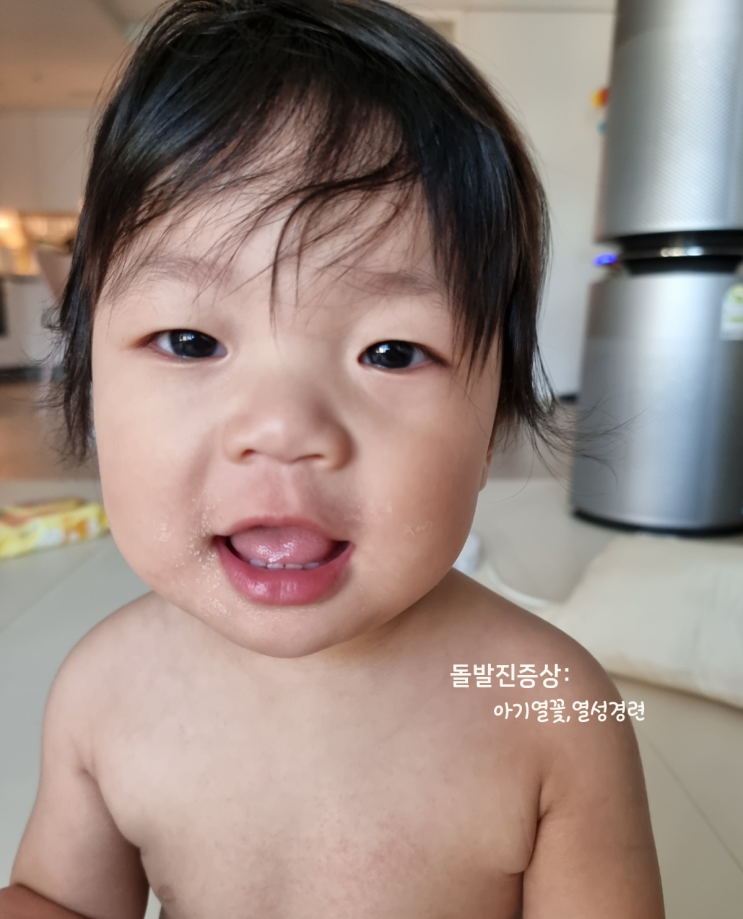  돌발진 아기 열꽃 증상 열성경련은