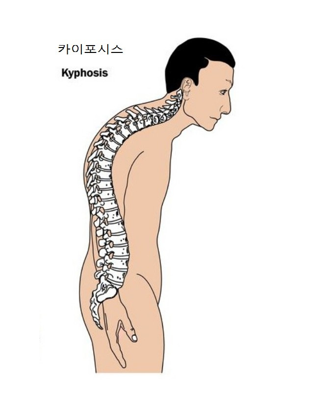 흉추후만증(Kyphosis)을 유발하는  근육 3가지와 운동방법