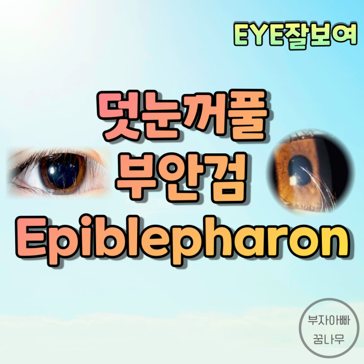 [EYE잘보여] 덧눈꺼풀(Epiblepharon), "속눈썹이 닿아요." - 원인, 증상, 진단, 치료