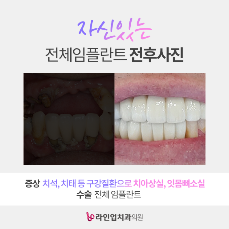  전체, 전악 임플란트 사례