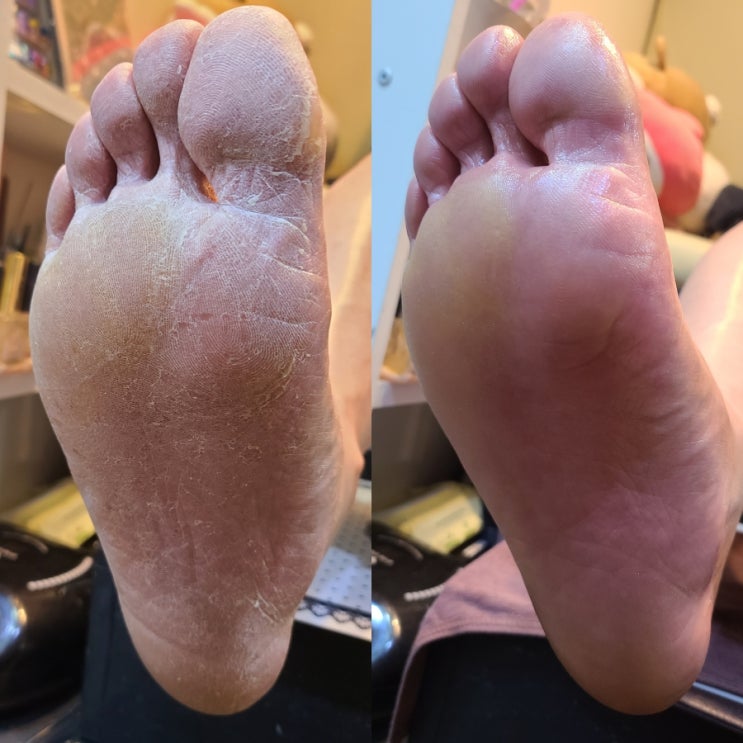  대구패디플래닝/칠곡발각질관리/북구패디관리전문샵/뒷꿈치각질관리