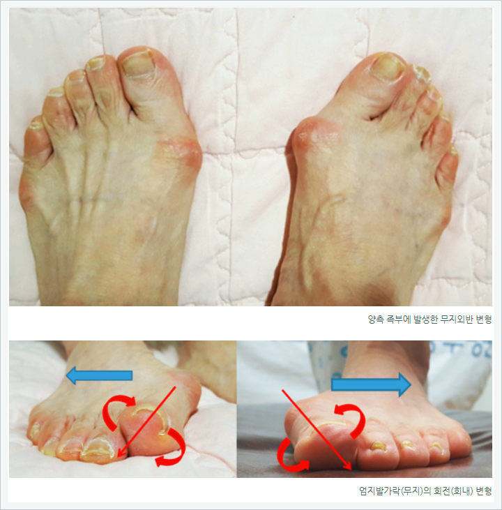  무지외반증수술잘하는병원, 이 글로 종결합니다.