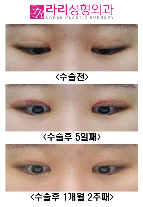 라리성형외과] 쌍꺼풀재수술 및 Roof 지방제거 : 네이버 블로그