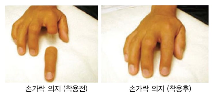  [포항 의수,의지 동성보조기] 의수, 의지 종류