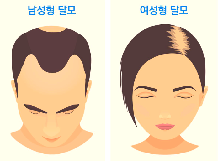  탈모예방 미리 준비해야 돼요