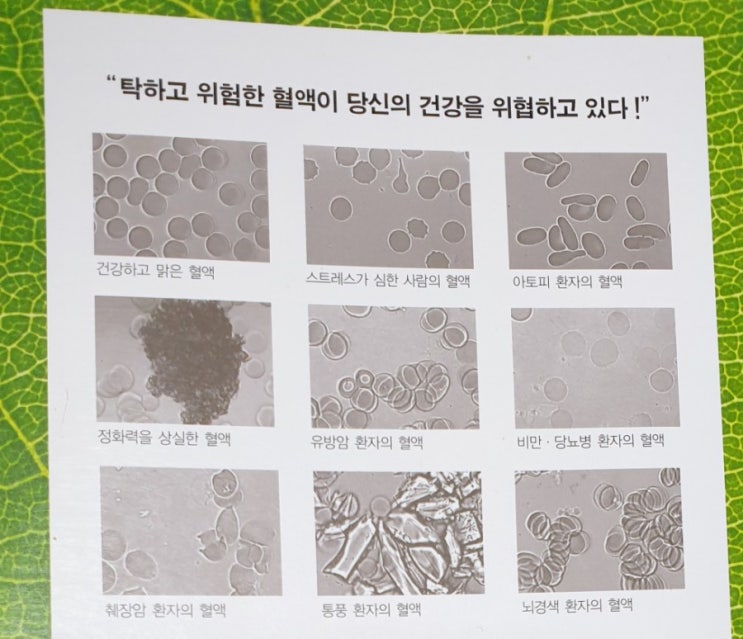  적혈구 연전현상 용혈현상 |  유니시티코리아 유여림