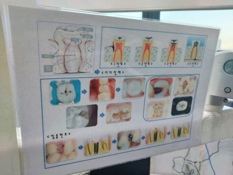  상악동거상술 치조골이식수술  수술비보험청구방법!